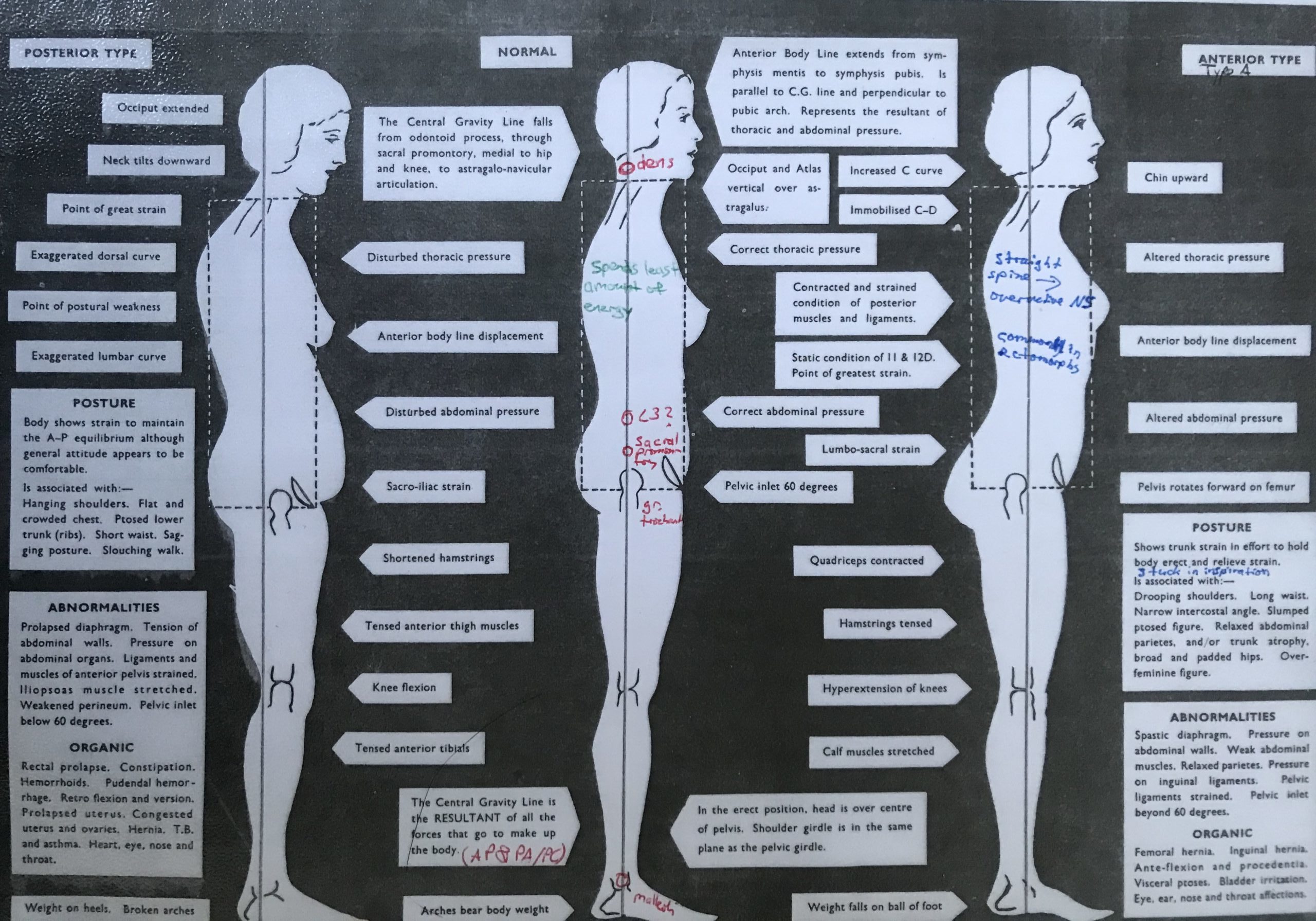 Poor posture and its effects - Laurie Melrose-Doering